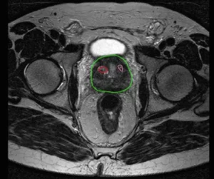 Fusie biopsie prostaat via huid wordt geprikt daarvoor worden mri beelden over echo beelden geprojecteerd