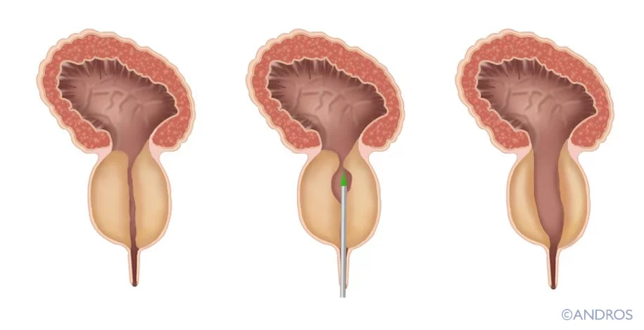 Green Light Laser Prostaat Uitleg Andros Clinics