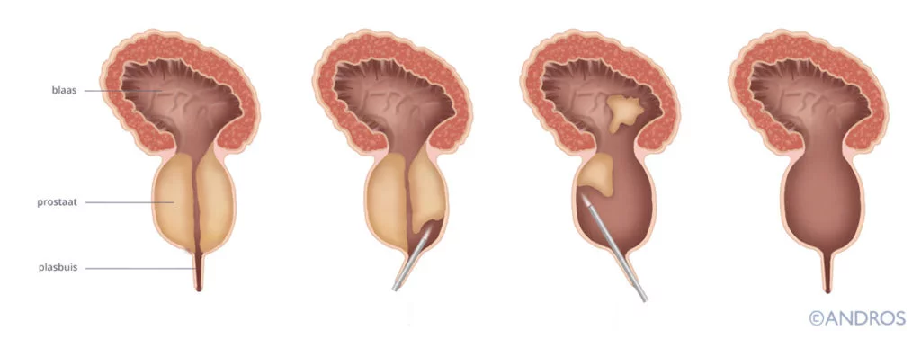 HoLEP laser prostaat wordt geheel leeg gemaakt zodat weefsel plasbuis niet meer dichtdrukt