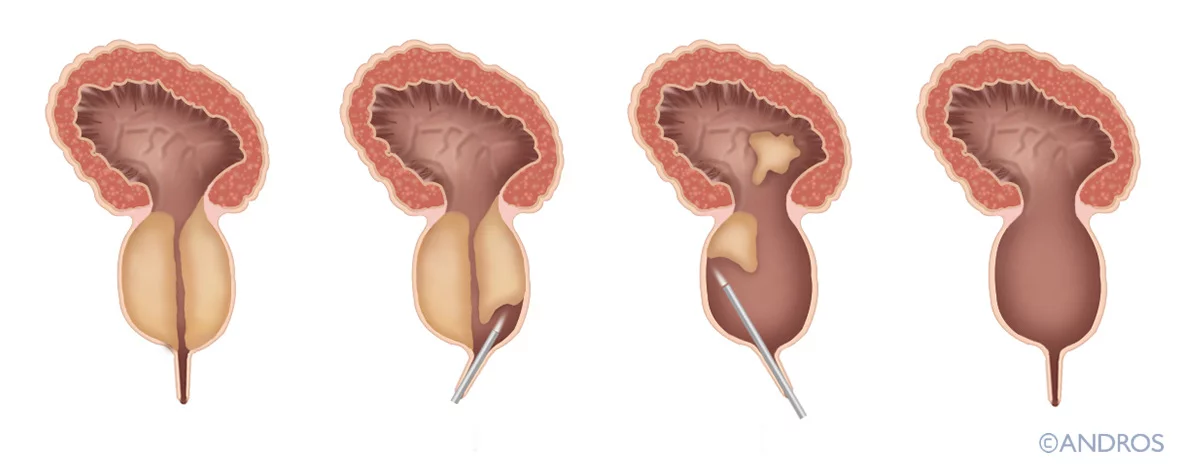 HoLEP laser prostaat wordt geheel leeg gemaakt zodat weefsel plasbuis niet meer dichtdrukt