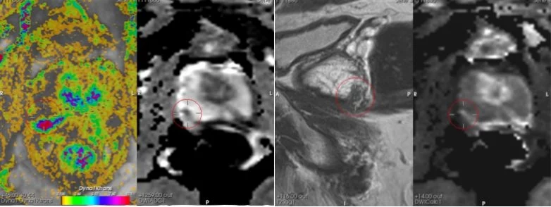 MRI Prostaa Uitslag PI-RADS score Andros Clinics