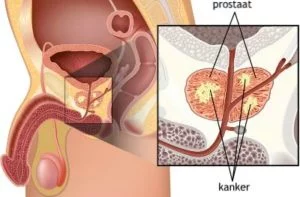 Symptomen Prostaatkanker treden pas laat op omdat de tumoren meestal niet nabij plasbuis ontstaan