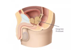 Vergrote prostaat Andros Clinics