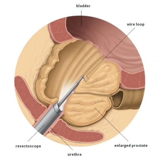 TURP operatie of prostaat laseren - Andros Clinics